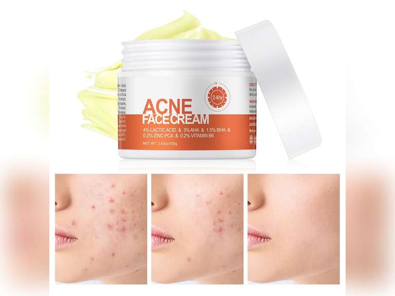 Acne Cream, Salicylic Acid Cystic Acne Treatment For Face, Back Butt Acne Treatments Creams, Acne Spot Treatment for Face Body, Acne Clearing Pimple Cream for Teens & Adults, Acne Moisturizer 10