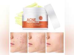 Acne Cream, Salicylic Acid Cystic Acne Treatment For Face, Back Butt Acne Treatments Creams, Acne Spot Treatment for Face Body, Acne Clearing Pimple Cream for Teens & Adults, Acne Moisturizer 10