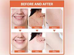 Acne Cream, Salicylic Acid Cystic Acne Treatment For Face, Back Butt Acne Treatments Creams, Acne Spot Treatment for Face Body, Acne Clearing Pimple Cream for Teens & Adults, Acne Moisturizer 10